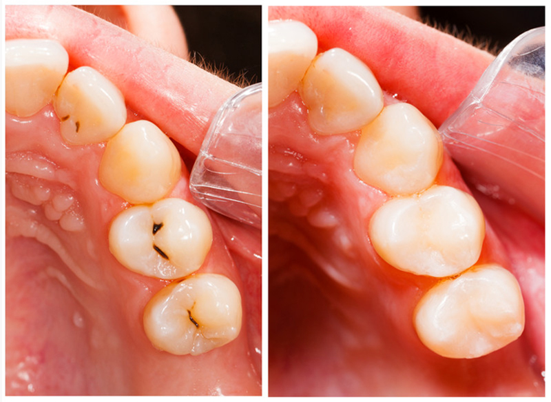 Fillings  New Baltimore, MI 