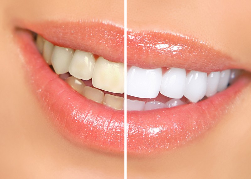 Teeth Whitening  New Baltimore, MI 